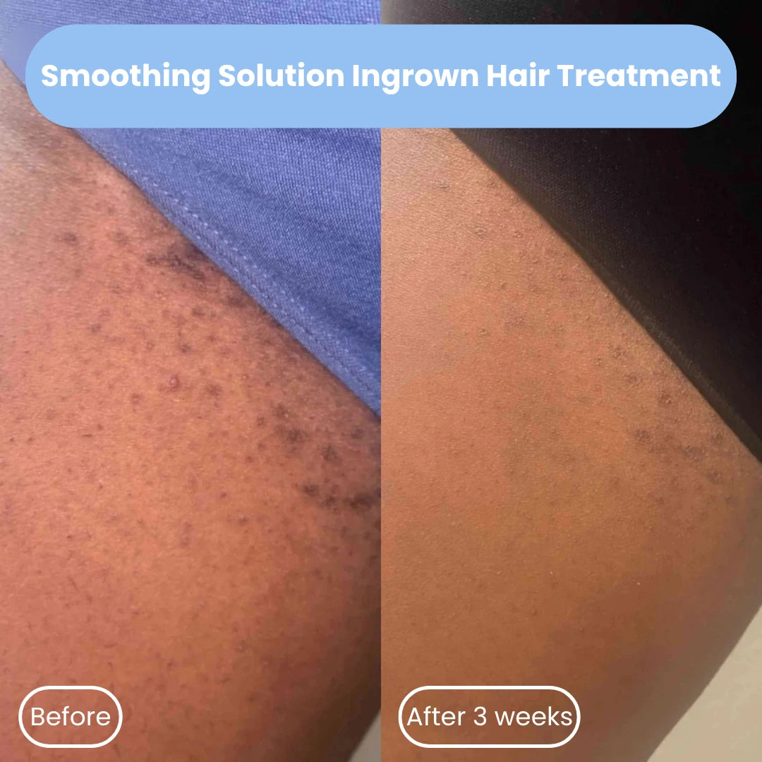 Smoothing Solution Ingrown Hair Treatment